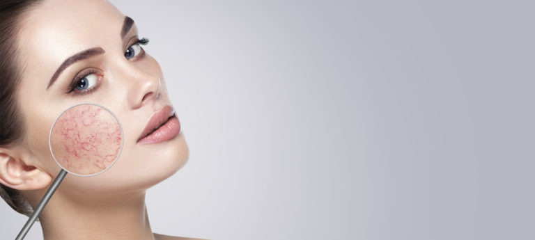 Ефективно и безопасно премахване на капиляри - Dias Dermatology